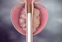 Фотографія Категорії Ліки для лікування аденоми простати