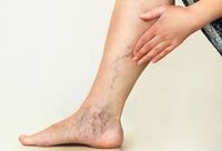 Фотографія Категорії Засоби для вен нижніх кінцівок