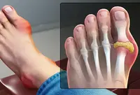 Фотографія Категорії Ліки при подагрі