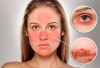 Фотографія Категорії Ліки від демодекозу