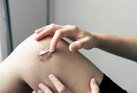 Фотографія Категорії Засоби проти рубців та шрамів