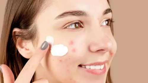 засоби від вугрів купити